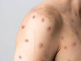 Brasil soma 90 casos de mpox nos dois primeiros meses de 2026. Veja sintomas, formas de transmissão e comparação com 2025